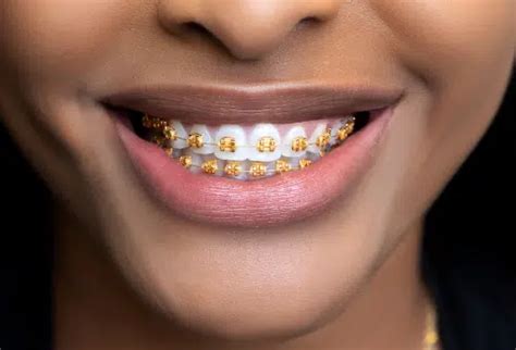 gold bracket braces and metal|real gold braces.